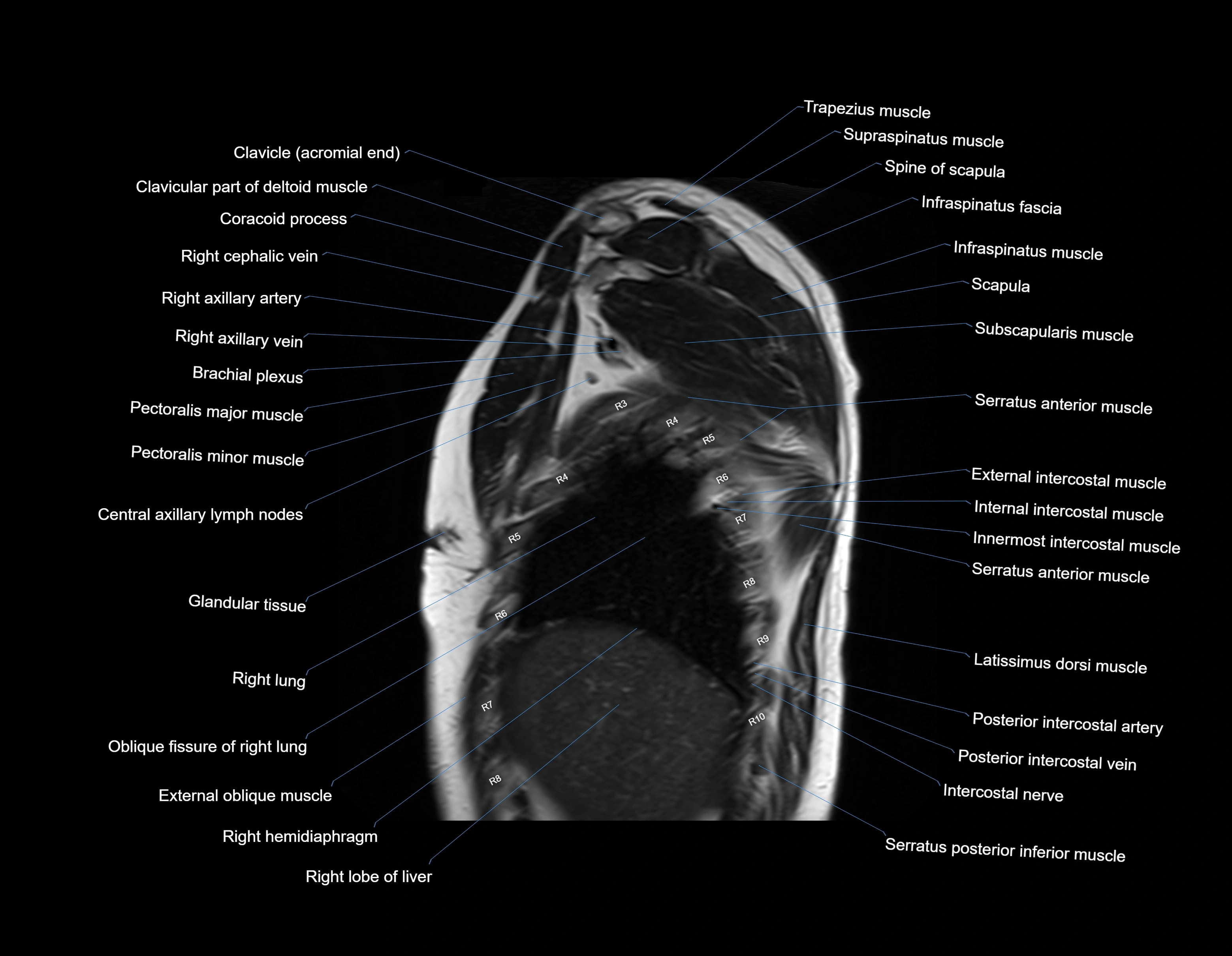 MRI chest (thorax) sagittal labelled cross sectional anatomy 3T radiology image-img-00001-00006.webp